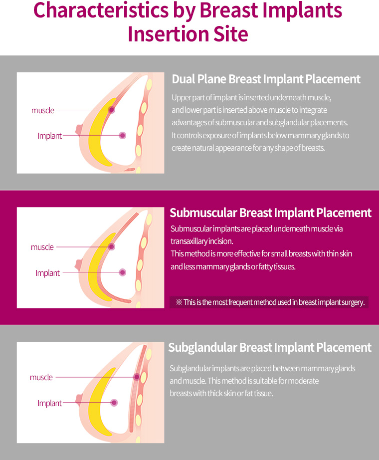 Characteristics by Breast Implants Insertion Site